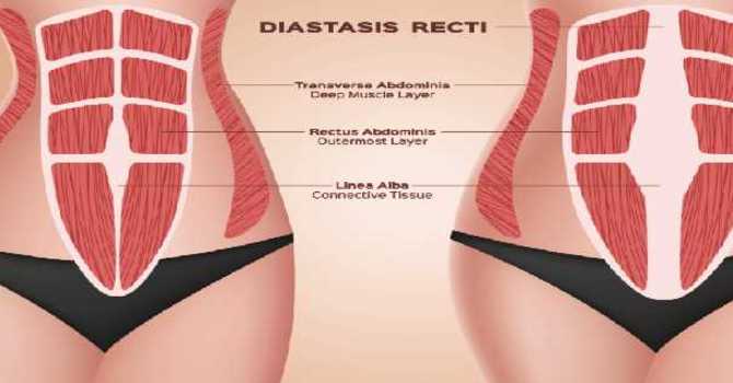 What is Diastasis Recti? image