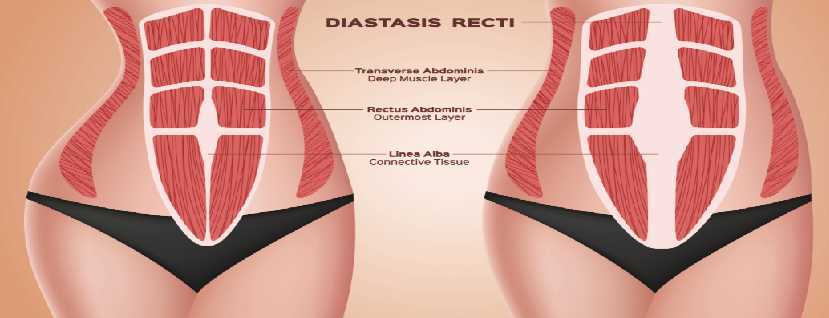 Diastasis recti - causes, prevention and treatment