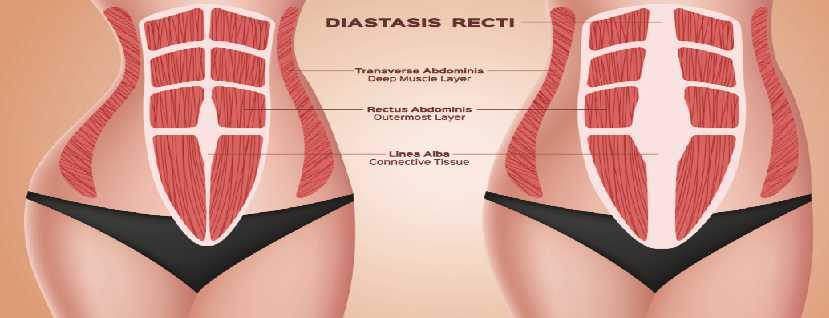 Diastasis Rectus Abdominus (DRA or DR) Separation of Abdominal